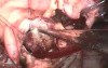 Excision of Cardiac tumor