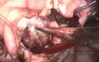 Excision of Cardiac tumor