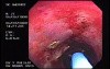 Radiation Proctosigmoiditis (10 of 14)