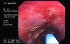 Radiation Proctosigmoiditis (10 of 14)
