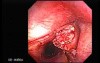 Egzophytic squamous cell carcinoma of the larynx - endoscopic biopsy 3/3