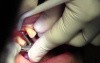 Implant Placement #5, Osteotomy Prep, Implant Insertion, Flap Advancement
