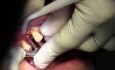 Implant Placement #5, Osteotomy Prep, Implant Insertion, Flap Advancement