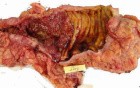 Adenocarcinoma of the Transverse Colon (10 of 15)