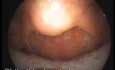 Hyperplasia of posterior pharyngeal wall