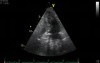 Left Atrial Compression