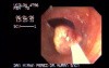 Stalked Polyp - Polypectomy
