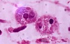 Close up of trophozoites of E. histolytica showing the
 nuclear appearance and erythrophagocytosis.

 