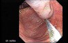 Colonoscopic Polypectomy (9 of 23)