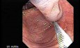 Colonoscopic Polypectomy (9 of 23)