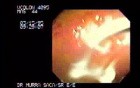 Flask Shaped Ulcer