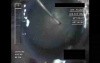 Cataract Surgery X - Part 1
