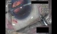 Cataract Surgery 2 - Part 3
