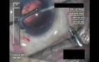 Cataract Surgery 2 - Part 3