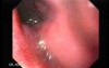 Adenocarcinoma of the Gastroesophageal Junction - Endoscopic Passage Through the Fistula 