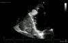 Big Right Ventricul Thrombus  DCM