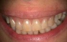 The Case Of The Missing Papillae, Part Deux