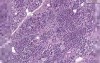 Pancreas - Adenocarcinoma