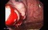 Gastric Varices - Endoscopic Ablation With Cyanoacrylate Glue (1 of 18)