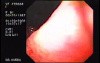 Giant Gastric Ulcer - Endoscopy (4 of 5)