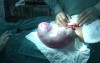 A Case of Benign Ovarian tumors Associated With Pregnancy