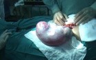 A Case of Benign Ovarian tumors Associated With Pregnancy