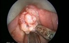 The Use of Microdebrider for Laryngeal Papillomatosis Removal