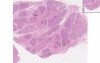 Breast - Hyperplasia Of Pregnancy