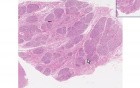 Breast - Hyperplasia Of Pregnancy