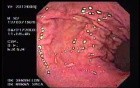 Acute Bleeding - Closer Look at the Source, Part 1