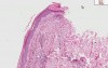 Skin- Leukocytoclastic Vasculitis