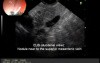 EUS diagnosis of insulinoma