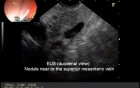 EUS diagnosis of insulinoma