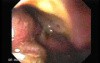 Presence of Multiple Irregular and Large Ulcers - Suspicion of Lymphoma