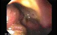 Presence of Multiple Irregular and Large Ulcers - Suspicion of Lymphoma