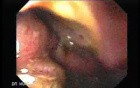 Presence of Multiple Irregular and Large Ulcers - Suspicion of Lymphoma
