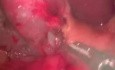 Cholecystectomy - SILS