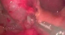 Cholecystectomy - SILS