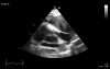 Transesophageal Echocardiography,  Right Ventricular Outflow Tract (RVOT) - Presence of Mediastinal Mass