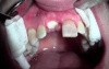 Extraction #8 With Socket Bone Grafting - D-Ptfe - Post-Op Healing - 2 Weeks Out