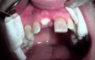 Extraction #8 With Socket Bone Grafting - D-Ptfe - Post-Op Healing - 2 Weeks Out