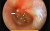 Acute Otitis Media - Early Stage