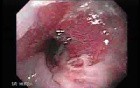 Hiatal Hernia - Above Is An Esophageal Stricture - 2/2