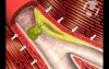 Unstable Plaques