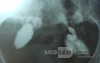 HSG HYDROSALPINX