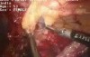 Adhesiolysis - laparoscopic surgery