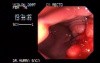 Endoscopy Of Rectal Adenocarcinoma (2 of 4)