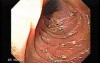 Gastroduodenal MALT lymphoma (3 of 9)