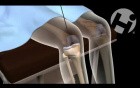 Open Reduction Internal Fixation of Tibia Fracture