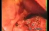 Lobectomy Due To A Tuberculous Cavern